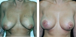 Breast Implant Revision Patient Before & After Photo 1