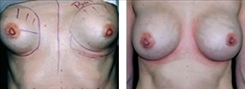 Breast Implant Revision Patient Before & After Photo 1