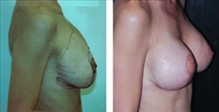 Breast Implant Revision Patient Before & After Photo 1