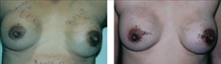 Breast Implant Revision Patient Before & After Photo 1