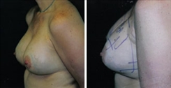 Breast Implant Revision Patient Before & After Photo 1