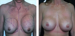 Breast Implant Revision Patient Before & After Photo 1