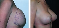 Breast Implant Revision Patient Before & After Photo 1