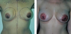 Breast Implant Revision Patient Before & After Photo 1