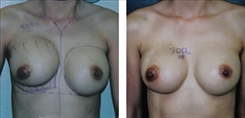 Breast Implant Revision Patient Before & After Photo 1