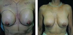 Breast Implant Revision Patient Before & After Photo 1