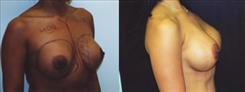 Breast Implant Revision Patient Before & After Photo 1