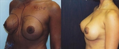 Breast Implant Revision Patient Before & After Photo 1