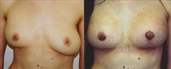 Breast Implant Revision Patient Before & After Photo 1