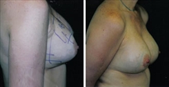 Breast Implant Revision Patient Before & After Photo 1