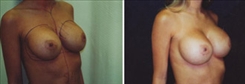 Breast Implant Revision Patient Before & After Photo 1