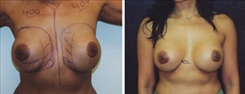 Breast Implant Revision Patient Before & After Photo 1