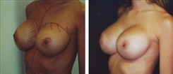 Breast Implant Revision Patient Before & After Photo 1