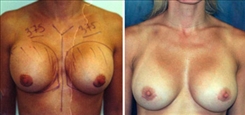 Breast Implant Revision Patient Before & After Photo 1