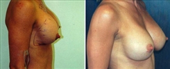 Breast Implant Revision Patient Before & After Photo 1