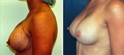 Breast Implant Revision Patient Before & After Photo 1