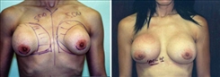 Breast Implant Revision Patient Before & After Photo 1