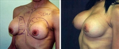 Breast Implant Revision Patient Before & After Photo 1