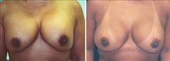 Breast Implant Revision Patient Before & After Photo 1