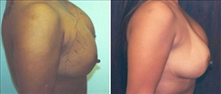 Breast Implant Revision Patient Before & After Photo 1