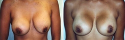 Breast Implant Revision Patient Before & After Photo 1