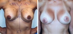 Breast Implant Revision Patient Before & After Photo 1