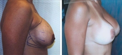 Breast Implant Revision Patient Before & After Photo 1