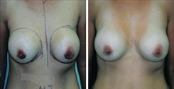 Breast Implant Revision Patient Before & After Photo 1