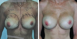 Breast Implant Revision Patient Before & After Photo 1