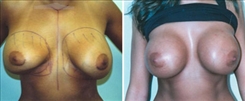 Breast Implant Revision Patient Before & After Photo 1