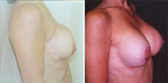 Breast Implant Revision Patient Before & After Photo 1