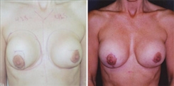 Breast Implant Revision Patient Before & After Photo 1