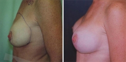 Breast Implant Revision Patient Before & After Photo 1