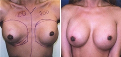 Breast Implant Revision Patient Before & After Photo 1