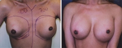 Breast Implant Revision Patient Before & After Photo 1