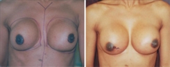 Breast Implant Revision Patient Before & After Photo 1