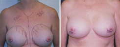 Breast Implant Revision Patient Before & After Photo 1