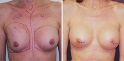 Breast Implant Revision Patient Before & After Photo 1