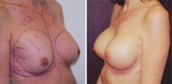 Breast Implant Revision Patient Before & After Photo 1