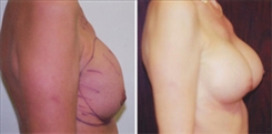 Breast Implant Revision Patient Before & After Photo 1