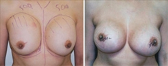 Breast Implant Revision Patient Before & After Photo 1