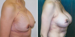 Breast Implant Revision Patient Before & After Photo 1