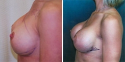 Breast Implant Revision Patient Before & After Photo 1