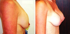 Breast Implant Revision Patient Before & After Photo 1