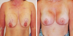 Breast Implant Revision Patient Before & After Photo 1