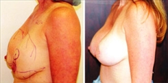 Breast Implant Revision Patient Before & After Photo 1