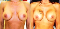 Breast Implant Revision Patient Before & After Photo 1