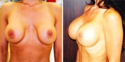 Breast Implant Revision Patient Before & After Photo 1