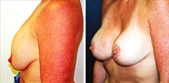 Breast Implant Revision Patient Before & After Photo 1