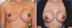 Breast Implant Revision Patient Before & After Photo 1